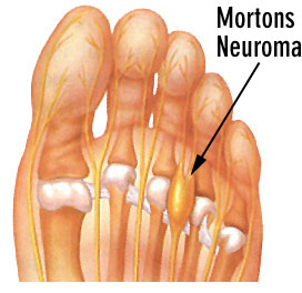 Foot showing Nerve affected by Morton’s Neuroma